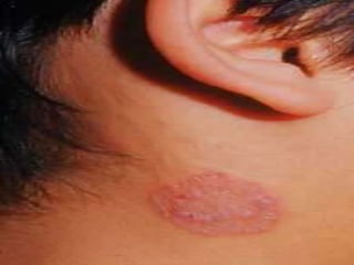 CandidiaseSistêmicaCandidíase sistêmica – é geralmente grave e suas principais localizações são: rim, cérebro, coração, trato digestivo, brônquios, pulmão e sangue.   Amanda