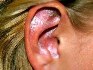 Candidiase Sistêmica - Sintomas – febre, mal estar em geral, dor muscular, erupção cutânea, endocardites (pacientes com defeitos vasculares, viciados em droga e pacientes imunocomprometidos). Presente em: 20%-40% = pacientes com câncer 25% = pacientes que recebem transplante de M.O.  Amanda