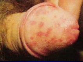 Candidiaseem mucosasMucosa vaginal – lesões semelhantes à boca com corrimento.Pacientes grávidas, diabéticas ou com terapêutica antimicrobiana prolongada.No homem = balanite (infecção da glande) como DST.  Mucosa cutânea – lesões eritematosas, crostosas e com exsudatos.Amanda