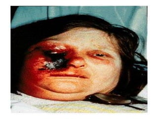 ZIGOMICOSES  Agente etiológico (Gênero):Phizopuss.p.Mucors.p.Absidias.p. As micoses produzidas por zigomicetos são denominados de zigomicoses ou mucormicoses.  As mucormicoses são geralmente graves. A infecção pode se localizar nos seios paranasais e cérebro, pulmões, aparelhos digestivos e em outros órgãos. A característica fundamental é a invasão dos vasos sanguíneos pelas hifas do fungo. A disseminação se faz através dos vasos sanguíneos, cartilagem nasal e nervos.  Amanda