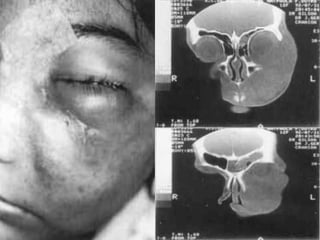 ZIGOMICOSES  Transmissão – A infecção só ocorre em pacientes imunodeprimidos e não se conhece a transmissão de pessoa a pessoa, podendo ser por via aérea, digestiva (pães úmidos) ou mucocutânea.  Diagnóstico laboratorial – Secreções e tecidos. Exame direto (microscópico) – hifas largas e contínuas, não septadas com ramificações em ângulo reto.    Amanda