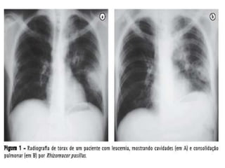 Corte histológico de lesão ulcero-necrótica da pele, mostrando hifas tortuosas,largas, de paredes finas, não paralelas, não septadas. Algumas apresentambifurcação em ângulo reto. Coloração PAS.