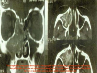 ASPERGILOSE  A aspergilose raramente ocorre como doença primária em indivíduos normais, acometendo indivíduos debilitados, imunodeprimidos ou que usam drogas imunossupressoras. Aspergilosealérgica (bronquite) = granjeiros, horticultores e jardineiros. Transmissão – Inalação de poeira (propágulos) Habitat natural – plantas, solos, materiais orgânicos em geral.  