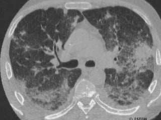 ASPERGILOSEDiagnóstico laboratorial: Secreções  Exame direto: hifas septadas, ramificadas dicotomicamente, irradiando de um ponto. Cultura: Sabouraud com cicloheximida. 