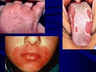 Tomografia computadorizada. Ocupação das cavidades paranasais à direita, insuflando-as com captação heterogênia de contraste. Expansão da lesão do seio maxilar para a caviadde nasal adjacente 