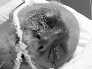 Caso Clínico 2Paciente, masculino R.F.A.,  61 anos.Relata que há cerca de 5 meses apresenta constante mialgia em membro inferior, o qual apresentou lesões ulcerativas após alguns dias do surgimento da dor.É portador de DM e HIV positiva há cerca de 12 anos.