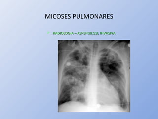 MICOSES PULMONARES
 RADIOLOGIA – ASPERGILOSE INVASIVARADIOLOGIA – ASPERGILOSE INVASIVA
 
