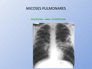 MICOSES PULMONARES
 RADIOLOGIA – ABPA + ASPERGILOMARADIOLOGIA – ABPA + ASPERGILOMA
 