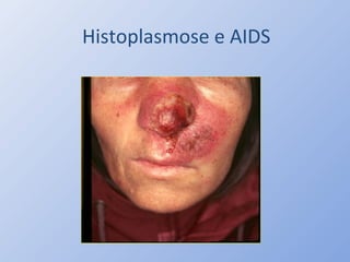Histoplasmose e AIDS
 