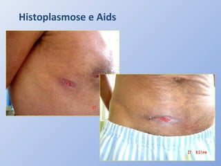 Histoplasmose e Aids
 