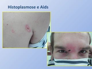 Histoplasmose e Aids
 