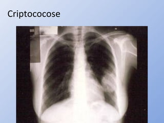 Criptococose
 