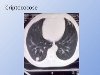 Criptococose
 