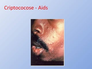 Criptococose - Aids
 