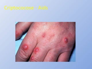 Criptococose - Aids
 