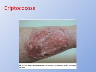 Criptococose
 
