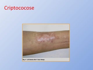 Criptococose
 