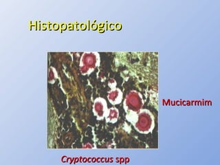 HistopatológicoHistopatológico
CryptococcusCryptococcus sppspp
MucicarmimMucicarmim
 