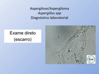 Aspergilose/Aspergiloma
Aspergillus spp
Diagnóstico laboratorial
Exame direto
(escarro)
 