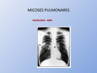 MICOSES PULMONARES
 RADIOLOGIA - ABPARADIOLOGIA - ABPA
 