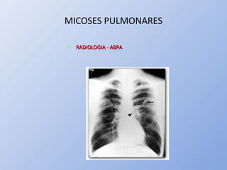 MICOSES PULMONARES
 RADIOLOGIA - ABPARADIOLOGIA - ABPA
 