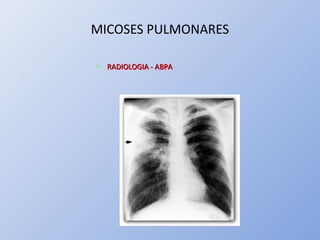 MICOSES PULMONARES
 RADIOLOGIA - ABPARADIOLOGIA - ABPA
 