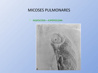 MICOSES PULMONARES
 RADIOLOGIA – ASPERGILOMARADIOLOGIA – ASPERGILOMA
 