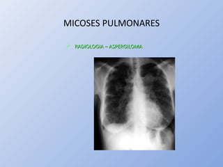 MICOSES PULMONARES
 RADIOLOGIA – ASPERGILOMARADIOLOGIA – ASPERGILOMA
 