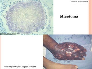 Fonte: htttp://infungicas.blogspot.com/2010 Micetoma Micoses subcutâneas 