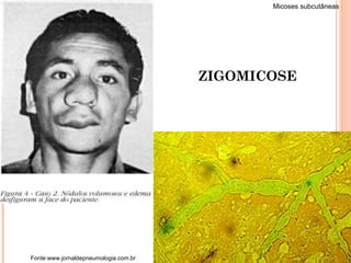 Fonte:www.jornaldepneumologia.com.br ZIGOMICOSE Micoses subcutâneas 