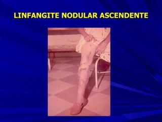 LINFANGITE NODULAR ASCENDENTE 