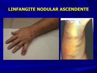 LINFANGITE NODULAR ASCENDENTE 