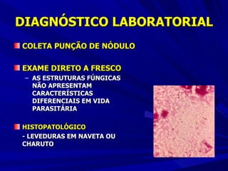 DIAGNÓSTICO LABORATORIAL COLETA PUNÇÃO DE NÓDULO EXAME DIRETO A FRESCO AS ESTRUTURAS FÚNGICAS NÃO APRESENTAM CARACTERÍSTICAS DIFERENCIAIS EM VIDA PARASITÁRIA HISTOPATOLÓGICO - LEVEDURAS EM NAVETA OU CHARUTO 