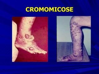 CROMOMICOSE 