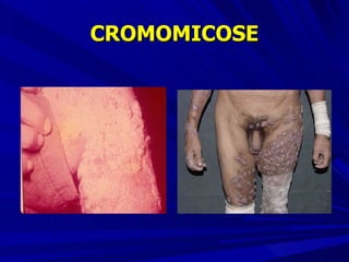 CROMOMICOSE 