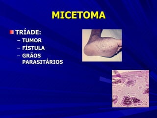 MICETOMA TRÍADE: TUMOR FÍSTULA GRÃOS PARASITÁRIOS 