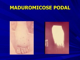 MADUROMICOSE PODAL 
