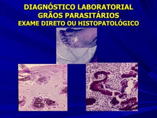 DIAGNÓSTICO LABORATORIAL GRÃOS PARASITÁRIOS EXAME DIRETO OU HISTOPATOLÓGICO 