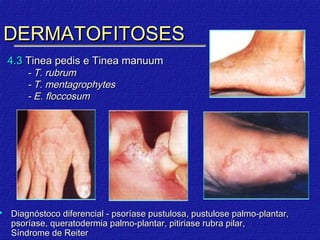 DERMATOFITOSES
    4.3 Tinea pedis e Tinea manuum
        - T. rubrum
        - T. mentagrophytes
        - E. floccosum




   Diagnóstoco diferencial - psoríase pustulosa, pustulose palmo-plantar,
    psoríase, queratodermia palmo-plantar, pitiriase rubra pilar,
    Síndrome de Reiter
 