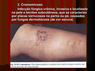 2. Cromomicose:
    Infecção fúngica crônica, invasiva e localizada
na pele e tecidos subcutâneos, que se caracteriza
por placas verrucosas na perna ou pé, causadas
por fungos dermatiáceos (de cor escura).
 