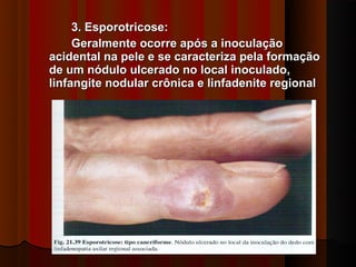 3. Esporotricose:
     Geralmente ocorre após a inoculação
acidental na pele e se caracteriza pela formação
de um nódulo ulcerado no local inoculado,
linfangite nodular crônica e linfadenite regional
 