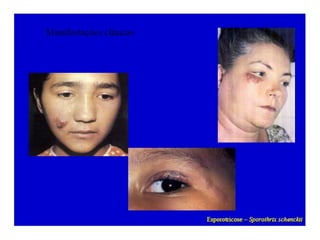 Micoses superficiais