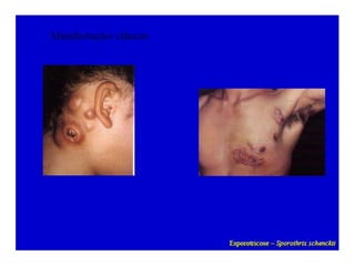 Micoses superficiais