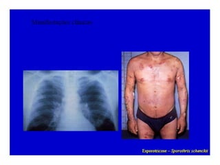 Micoses superficiais