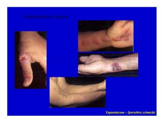 Micoses superficiais