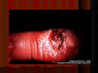 Micoses superficiais