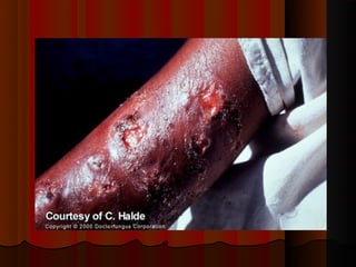 Micoses superficiais