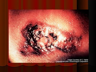 Micoses superficiais