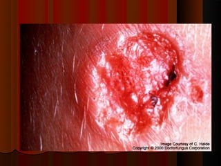 Micoses superficiais