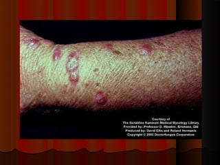 Micoses superficiais